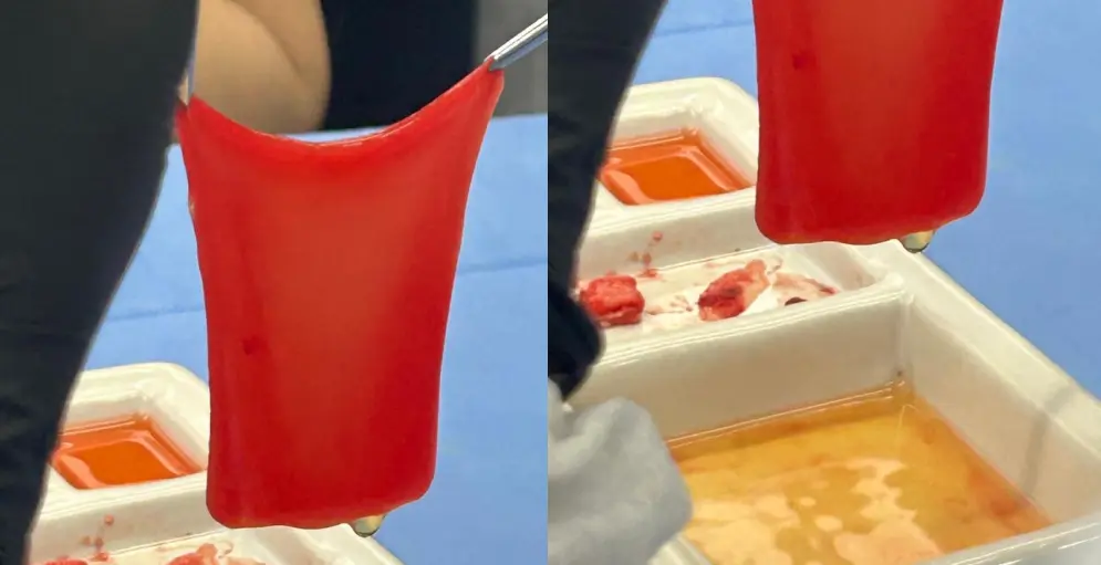 Tratamento de Matriz de Fibrina Autóloga Leucoplaquetária - Instituto Juliana Bertollini